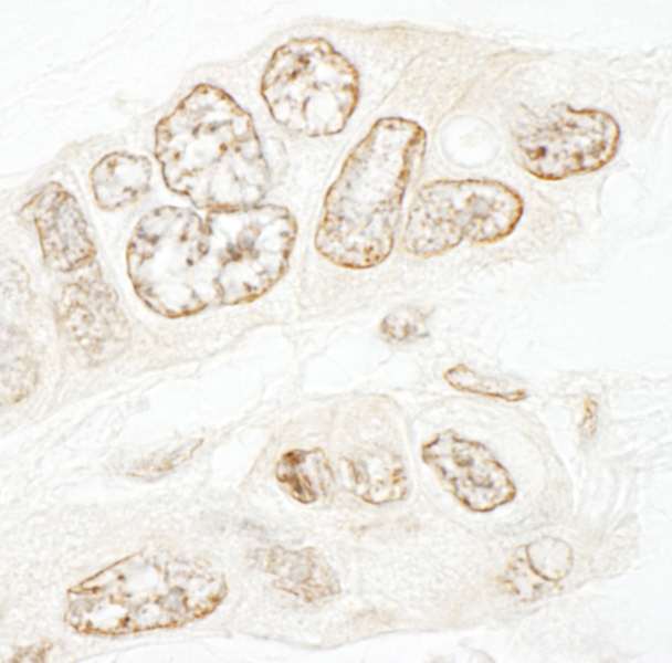 SETD1B / SET1B Antibody - Detection of Human hSET1B by Immunohistochemistry. Sample: FFPE section of human ovarian carcinoma. Antibody: Affinity purified rabbit anti-hSET1B used at a dilution of 1:1000 (1 Detection: DAB.
