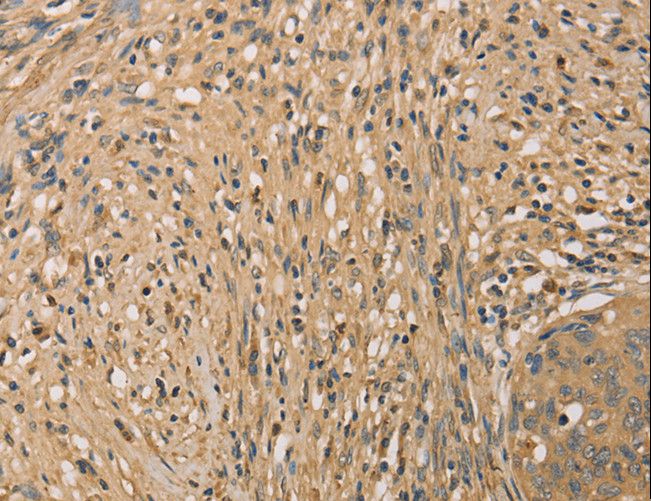 SETD2 Antibody - Immunohistochemistry of paraffin-embedded Human cervical cancer using SETD2 Polyclonal Antibody at dilution of 1:40.