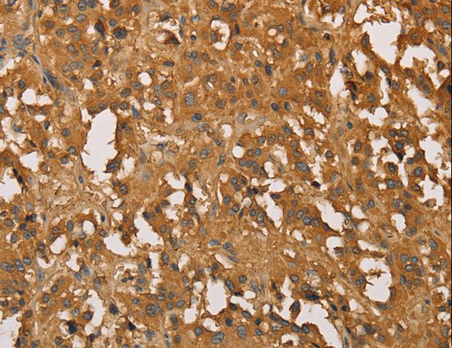 SETD2 Antibody - Immunohistochemistry of paraffin-embedded Human thyroid cancer using SETD2 Polyclonal Antibody at dilution of 1:30.