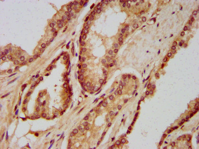 SETD3 Antibody - Immunohistochemistry image at a dilution of 1:400 and staining in paraffin-embedded human prostate cancer performed on a Leica BondTM system. After dewaxing and hydration, antigen retrieval was mediated by high pressure in a citrate buffer (pH 6.0) . Section was blocked with 10% normal goat serum 30min at RT. Then primary antibody (1% BSA) was incubated at 4 °C overnight. The primary is detected by a biotinylated secondary antibody and visualized using an HRP conjugated SP system.