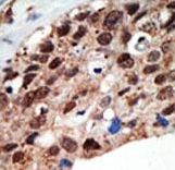 SETD7 / SET7 Antibody - Formalin-fixed and paraffin-embedded human cancer tissue reacted with the primary antibody, which was peroxidase-conjugated to the secondary antibody, followed by DAB staining. This data demonstrates the use of this antibody for immunohistochemistry; clinical relevance has not been evaluated. BC = breast carcinoma; HC = hepatocarcinoma.