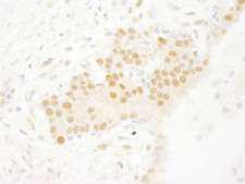 SETD7 / SET7 Antibody - Detection of Human SET7 by Immunohistochemistry. Sample: FFPE section of human prostate carcinoma. Antibody: Affinity purified rabbit anti-SET7 used at a dilution of 1:250.