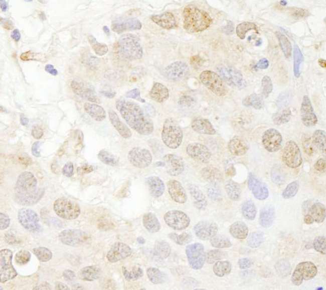 SETD7 / SET7 Antibody - Detection of Human SET7 by Immunohistochemistry. Sample: FFPE section of human breast carcinoma. Antibody: Affinity purified rabbit anti-SET7 used at a dilution of 1:250.