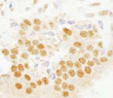 SETD7 / SET7 Antibody - Detection of Human SET7 by Immunohistochemistry. Sample: FFPE section of human prostate carcinoma. Antibody: Affinity purified rabbit anti-SET7 used at a dilution of 1:1000 (0.2 ug/ml). Detection: DAB.