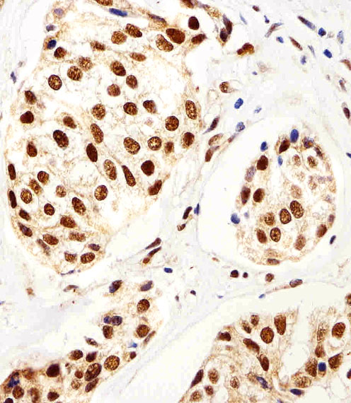SETD8 / SET8 Antibody - Immunohistochemical of paraffin-embedded H.breast carcinoma section using SET07 Antibody. Antibody was diluted at 1:25 dilution. A peroxidase-conjugated goat anti-rabbit IgG at 1:400 dilution was used as the secondary antibody, followed by DAB staining.