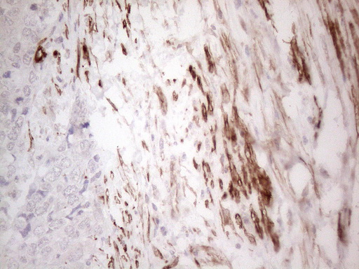 SETD8 / SET8 Antibody - Immunohistochemical staining of paraffin-embedded Adenocarcinoma of Human endometrium tissue using anti-SETD8 mouse monoclonal antibody. (Heat-induced epitope retrieval by 1mM EDTA in 10mM Tris buffer. (pH8.5) at 120°C for 3 min. (1:150)