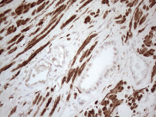 SETD8 / SET8 Antibody - Immunohistochemical staining of paraffin-embedded Carcinoma of Human prostate tissue using anti-SETD8 mouse monoclonal antibody. (Heat-induced epitope retrieval by 1mM EDTA in 10mM Tris buffer. (pH8.5) at 120°C for 3 min. (1:150)