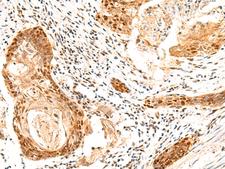 SETMAR Antibody - Immunohistochemistry of paraffin-embedded Human esophagus cancer tissue  using SETMAR Polyclonal Antibody at dilution of 1:60(×200)