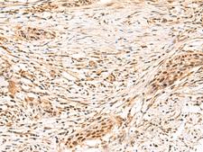 SETMAR Antibody - Immunohistochemistry of paraffin-embedded Human esophagus cancer tissue  using SETMAR Polyclonal Antibody at dilution of 1:100(×200)