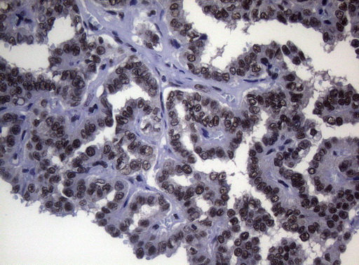 SF1 Antibody - Immunohistochemical staining of paraffin-embedded Carcinoma of Human thyroid tissue using anti-SF1 mouse monoclonal antibody. (Heat-induced epitope retrieval by 1mM EDTA in 10mM Tris buffer. (pH8.5) at 120°C for 3 min. (1:150)