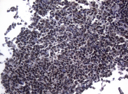 SF1 Antibody - Immunohistochemical staining of paraffin-embedded Human lymphoma tissue using anti-SF1 mouse monoclonal antibody. (Heat-induced epitope retrieval by 1mM EDTA in 10mM Tris buffer. (pH8.5) at 120°C for 3 min. (1:150)