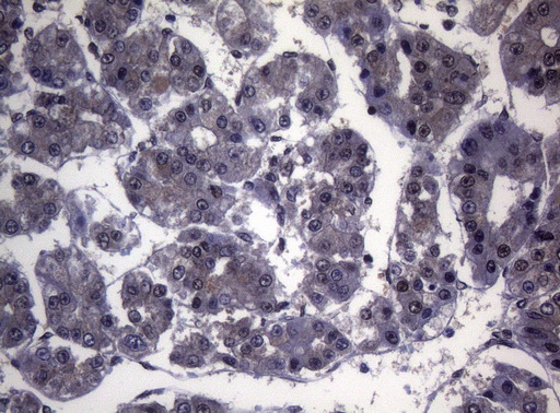 SF1 Antibody - Immunohistochemical staining of paraffin-embedded Carcinoma of Human liver tissue using anti-SF1 mouse monoclonal antibody. (Heat-induced epitope retrieval by 1mM EDTA in 10mM Tris buffer. (pH8.5) at 120°C for 3 min. (1:150)