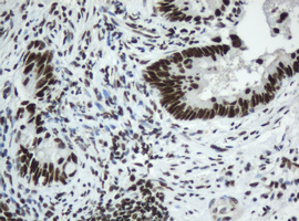 SF3A1 / SF3A120 Antibody - IHC of paraffin-embedded Adenocarcinoma of Human colon tissue using anti-SF3A1 mouse monoclonal antibody.