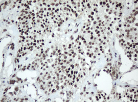 SF3A1 / SF3A120 Antibody - IHC of paraffin-embedded Carcinoma of Human pancreas tissue using anti-SF3A1 mouse monoclonal antibody.