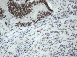 SF3A1 / SF3A120 Antibody - IHC of paraffin-embedded Adenocarcinoma of Human colon tissue using anti-SF3A1 mouse monoclonal antibody. (Heat-induced epitope retrieval by 10mM citric buffer, pH6.0, 120°C for 3min).