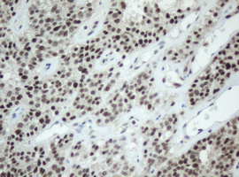 SF3A1 / SF3A120 Antibody - IHC of paraffin-embedded Carcinoma of Human pancreas tissue using anti-SF3A1 mouse monoclonal antibody. (Heat-induced epitope retrieval by 10mM citric buffer, pH6.0, 120°C for 3min).