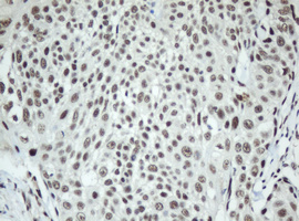 SF3A1 / SF3A120 Antibody - IHC of paraffin-embedded Carcinoma of Human bladder tissue using anti-SF3A1 mouse monoclonal antibody. (Heat-induced epitope retrieval by 10mM citric buffer, pH6.0, 120°C for 3min).