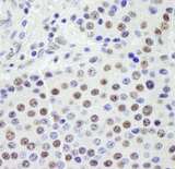 SF3A1 / SF3A120 Antibody - Detection of Human SF3a120/SAP114 by Immunohistochemistry. Sample: FFPE section of human pancreatic islet cell tumor. Antibody: Affinity purified rabbit anti-SF3a120/SAP114 used at a dilution of 1:250.