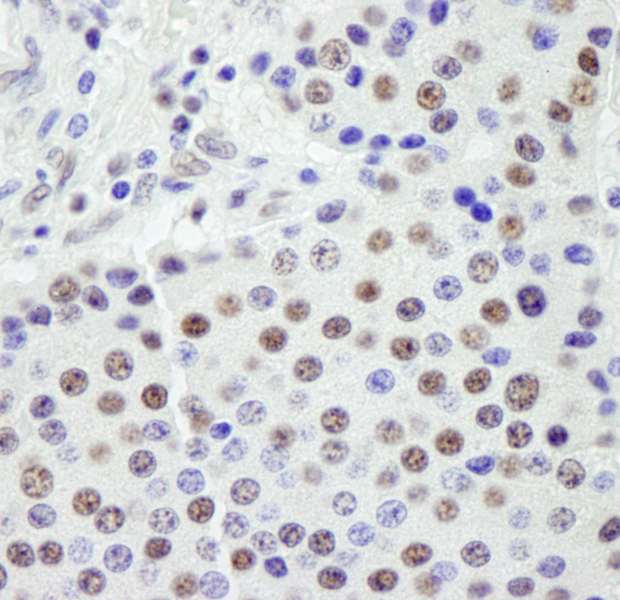 SF3A1 / SF3A120 Antibody - Detection of Human SF3a120/SAP114 by Immunohistochemistry. Sample: FFPE section of human pancreatic islet cell tumor. Antibody: Affinity purified rabbit anti-SF3a120/SAP114 used at a dilution of 1:250.