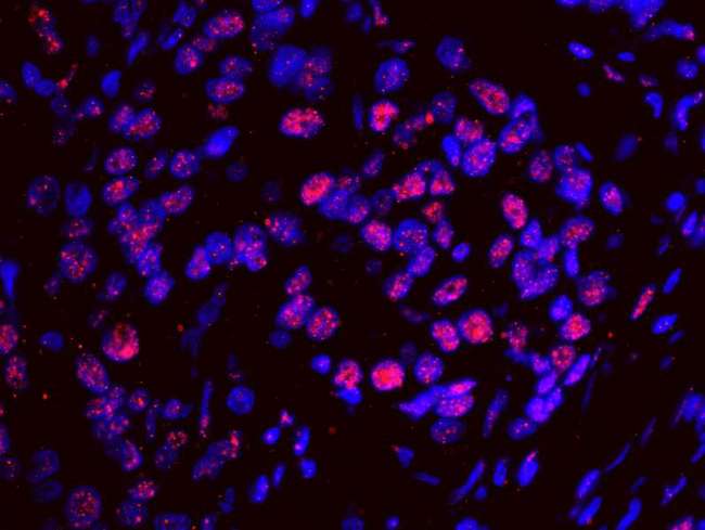 SF3A1 / SF3A120 Antibody - Detection of Human SF3a120/SAP114 by IHC-IF. Sample: FFPE section of human breast carcinoma. Antibody: Affinity purified rabbit anti-SF3a120/SAP114 used at a dilution of 1:100. Detection: Red-fluorescent goat anti-rabbit IgG highly cross-adsorbed Antibody used at a dilution of 1:100.