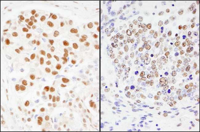 SF3A1 / SF3A120 Antibody - Detection of Human and Mouse SF3a120/SAP114 by Immunohistochemistry. Sample: FFPE sections of human breast carcinoma (left) and mouse teratoma (right). Antibody: Affinity purified rabbit anti-SF3a120/SAP114 used at a dilution of 1:200 (1 ug/ml). Detection: DAB.