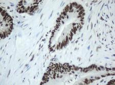 SF3A1 / SF3A120 Antibody - IHC of paraffin-embedded Adenocarcinoma of Human colon tissue using anti-SF3A1 mouse monoclonal antibody.