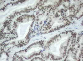 SF3A1 / SF3A120 Antibody - IHC of paraffin-embedded Adenocarcinoma of Human endometrium tissue using anti-SF3A1 mouse monoclonal antibody.