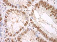 SF3A3 / SF3a60 Antibody - Detection of Human SF3A3 by Immunohistochemistry. Sample: FFPE section of human colon carcinoma. Antibody: Affinity purified rabbit anti-SF3A3 used at a dilution of 1:250.