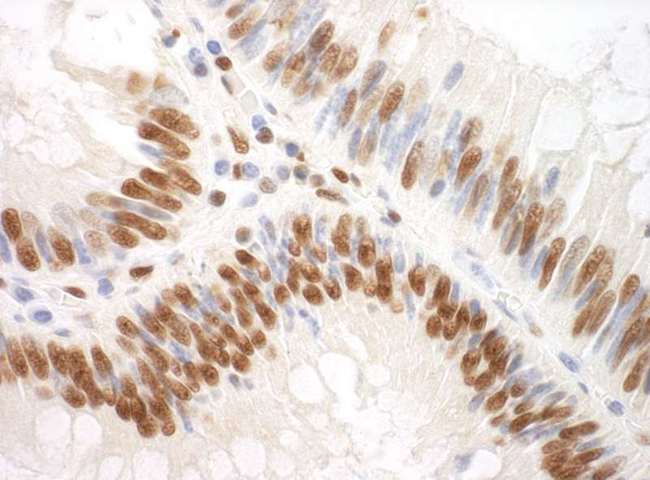 SF3A3 / SF3a60 Antibody - Detection of Human SF3A3 by Immunohistochemistry. Sample: FFPE section of human colon carcinoma. Antibody: Affinity purified rabbit anti-SF3A3 used at a dilution of 1:200 (1 ug/ml). Detection: DAB.
