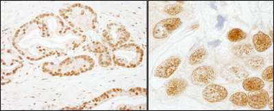 SF3B1 Antibody - Detection of Human SF3b155/SAP155 by Immunohistochemistry. Sample: FFPE section of human prostate carcinoma. Antibody: Affinity purified rabbit anti-SF3b155/SAP155 used at a dilution of 1:200 (1 ug/ml). Detection: DAB.