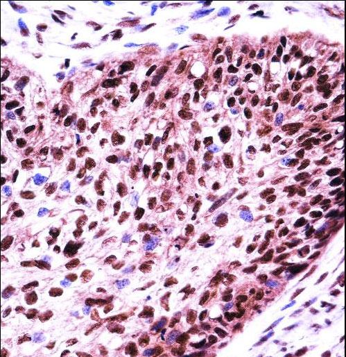 SF3B1 Antibody - SF3B1 Antibody immunohistochemistry of formalin-fixed and paraffin-embedded human esophagus carcinoma followed by peroxidase-conjugated secondary antibody and DAB staining.