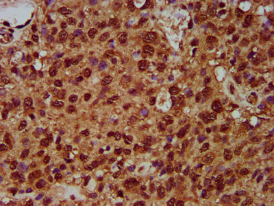 SF3B1 Antibody - Immunohistochemistry Dilution at 1:200 and staining in paraffin-embedded human glioma cancer performed on a Leica BondTM system. After dewaxing and hydration, antigen retrieval was mediated by high pressure in a citrate buffer (pH 6.0). Section was blocked with 10% normal Goat serum 30min at RT. Then primary antibody (1% BSA) was incubated at 4°C overnight. The primary is detected by a biotinylated Secondary antibody and visualized using an HRP conjugated SP system.