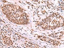 SF3B130 / SF3B3 Antibody - Immunohistochemistry of paraffin-embedded Human esophagus cancer tissue  using SF3B3 Polyclonal Antibody at dilution of 1:70(×200)