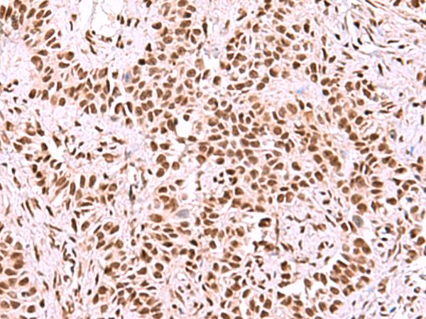 SF3B130 / SF3B3 Antibody - Immunohistochemistry of paraffin-embedded Human ovarian cancer tissue  using SF3B3 Polyclonal Antibody at dilution of 1:50(×200)