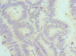 SF3B2 Antibody - Immunohistochemistry of paraffin-embedded human colon cancer using antibody at 1:100 dilution.
