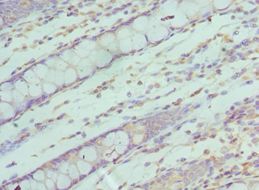 SF3B2 Antibody - Immunohistochemistry of paraffin-embedded human rectal cancer using antibody at 1:100 dilution.