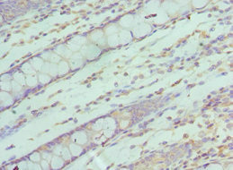SF3B2 Antibody - Immunohistochemistry of paraffin-embedded human colon cancer using SF3B2 Antibody at dilution of 1:100