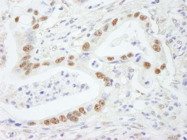 SF3B2 Antibody - Detection of Human SF3b145/SAP145 by Immunohistochemistry. Sample: FFPE section of human stomach carcinoma. Antibody: Affinity purified rabbit anti-SF3b145/SAP145 used at a dilution of 1:250.