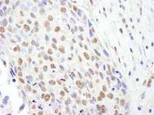 SF3B2 Antibody - Detection of Human SF3b145/SAP145 by Immunohistochemistry. Sample: FFPE section of human breast carcinoma. Antibody: Affinity purified rabbit anti-SF3b145/SAP145 used at a dilution of 1:200 (1 ug/ml). Detection: DAB.