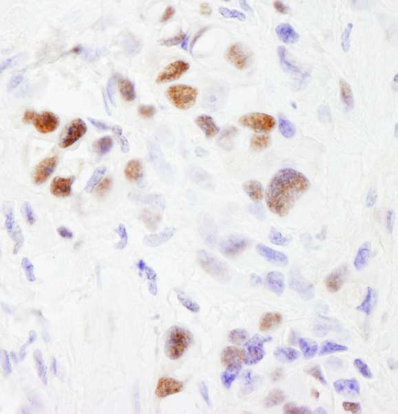SF3B2 Antibody - Detection of Human SF3b145/SAP145 by Immunohistochemistry. Sample: FFPE section of human linitis plastica stomach cancer. Antibody: Affinity purified rabbit anti-SF3b145/SAP145 used at a dilution of 1:200 (1 ug/ml). Detection: DAB.