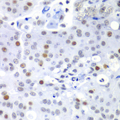 SF3B2 Antibody - Immunohistochemistry of paraffin-embedded human oophoroma tissue.
