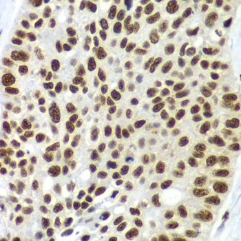 SF3B2 Antibody - Immunohistochemistry of paraffin-embedded human lung cancer tissue.