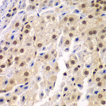SF3B2 Antibody - Immunohistochemistry of paraffin-embedded human liver cancer tissue.