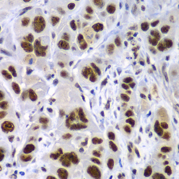 SF3B2 Antibody - Immunohistochemistry of paraffin-embedded human gastric cancer tissue.
