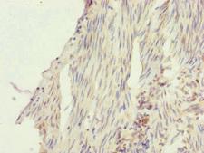 SFI1 Antibody - Immunohistochemistry of paraffin-embedded human bladder cancer at dilution of 1:100