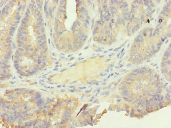 SFI1 Antibody - Immunohistochemistry of paraffin-embedded human endometrial cancer at dilution of 1:100