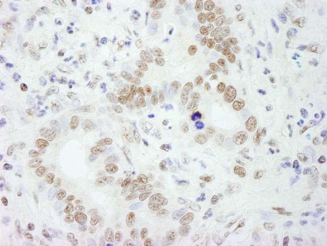 SFPQ Antibody - Detection of Human PSF/SFPQ by Immunohistochemistry. Sample: FFPE section of human colon carcinoma. Antibody: Affinity purified rabbit anti-PSF/SFPQ used at a dilution of 1:200 (1 ug/ml). Detection: DAB.