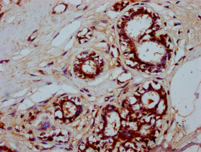 SFR1 / C10orf78 Antibody - Immunohistochemistry Dilution at 1:200 and staining in paraffin-embedded human breast cancer performed on a Leica BondTM system. After dewaxing and hydration, antigen retrieval was mediated by high pressure in a citrate buffer (pH 6.0). Section was blocked with 10% normal Goat serum 30min at RT. Then primary antibody (1% BSA) was incubated at 4°C overnight. The primary is detected by a biotinylated Secondary antibody and visualized using an HRP conjugated SP system.