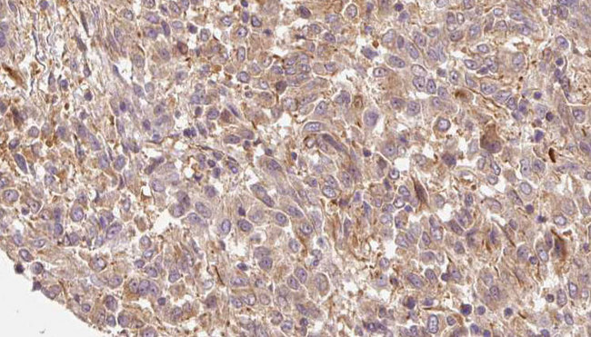 SFRP-3 / FRZB Antibody - 1:100 staining human Melanoma tissue by IHC-P. The sample was formaldehyde fixed and a heat mediated antigen retrieval step in citrate buffer was performed. The sample was then blocked and incubated with the antibody for 1.5 hours at 22°C. An HRP conjugated goat anti-rabbit antibody was used as the secondary.