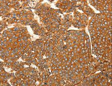 SFRP1 Antibody - Immunohistochemistry of paraffin-embedded Human lung cancer using SFRP1 Polyclonal Antibody at dilution of 1:80.